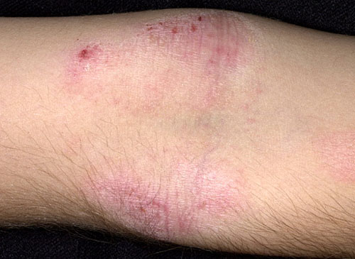 La apreciación atopicheskogo de la dermatitis